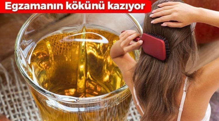 Egzama, kepek ve kaşıntının kökünü kurutuyor: Gece sürüp sabaha kadar bekletin