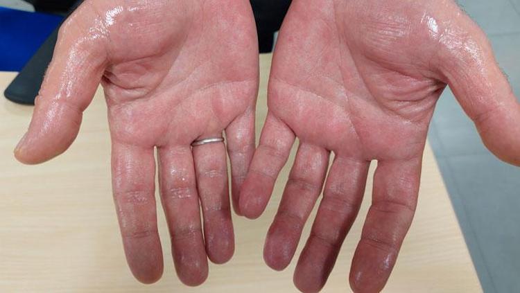 DÜNYA ÇAPINDA YAKLAŞIK 220 MİLYON KİŞİDE GÖRÜLÜYOR