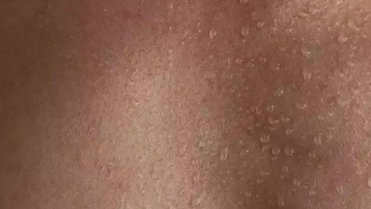 Dünya nüfusunun yüzde 3’ünde görülüyor Sosyal fobiden depresyona kadar sayısız soruna yol açıyor: Sandığınız gibi sıradan bir sorun olmayabilir