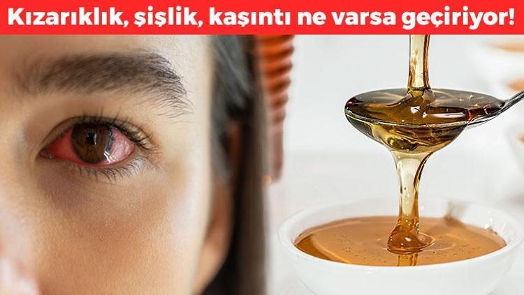 Gözdeki alerjiyi silip atıyor 1 kaşık balla karıştırmak yetiyor: Kızarıklık, şişlik, kaşıntı ne varsa anında geçiriyor