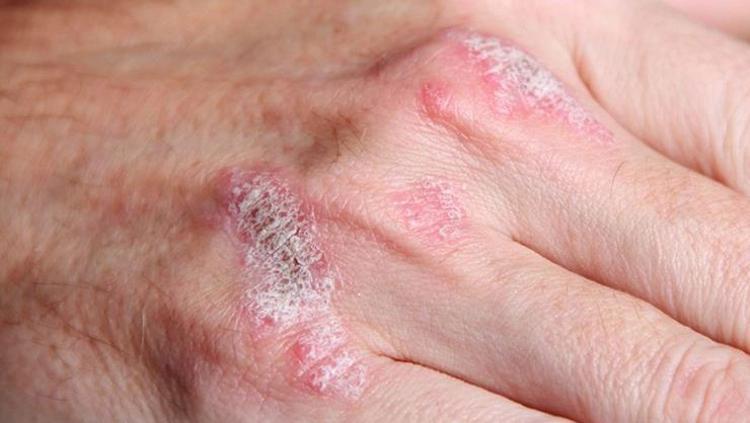 ABD’li bilim insanları korkunç gerçeği açığa çıkardı O besini yediğiniz anda egzamayı tetikliyor: Fazlası ciltte birikip iltihaplanmaya yol açıyor