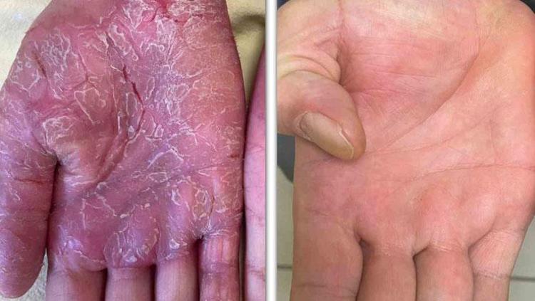 CİLTTE KIZARIKLIKLA KENDİNİ GÖSTERİYOR