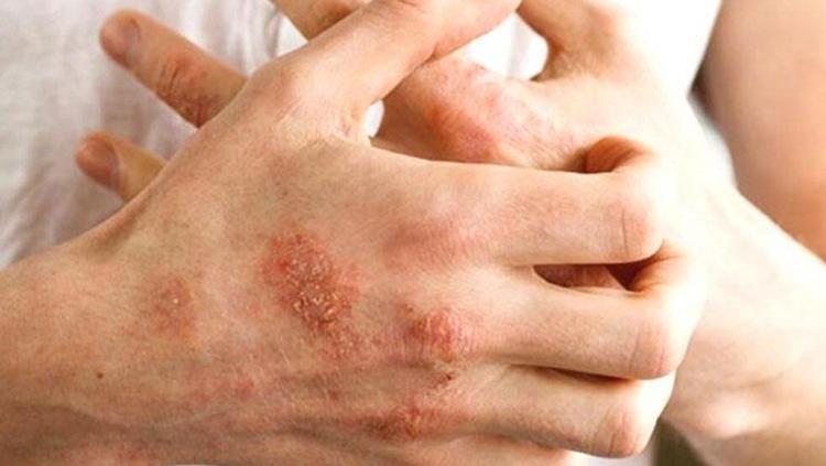 ABD’Lİ BİLİM İNSANLARI EGZAMAYI TETİKLEYEN O BESİNİ BULDU