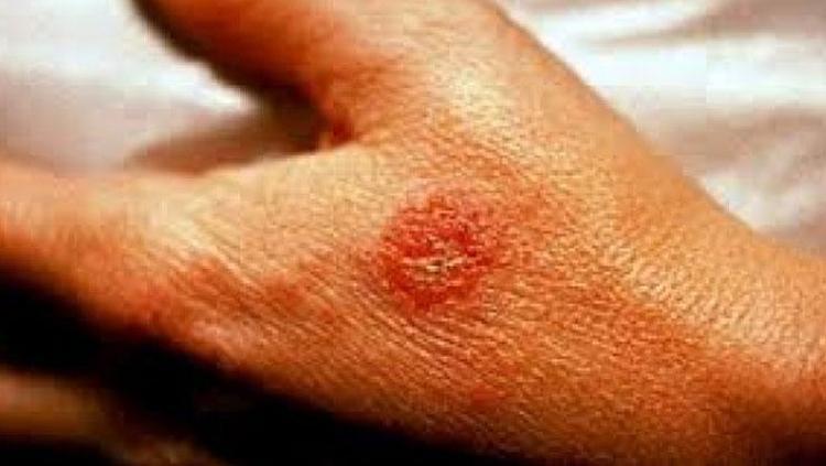 ABD’li bilim insanları korkunç gerçeği açığa çıkardı O besini yediğiniz anda egzamayı tetikliyor: Fazlası ciltte birikip iltihaplanmaya yol açıyor