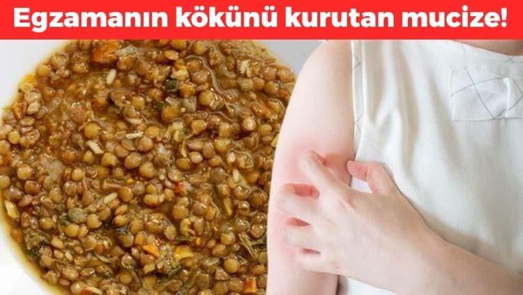 Kaşığın ucuyla yemek bile yetiyor Egzama, sedef ve mantarın kökünü kazıyıp cildi bebek gibi yapıyor