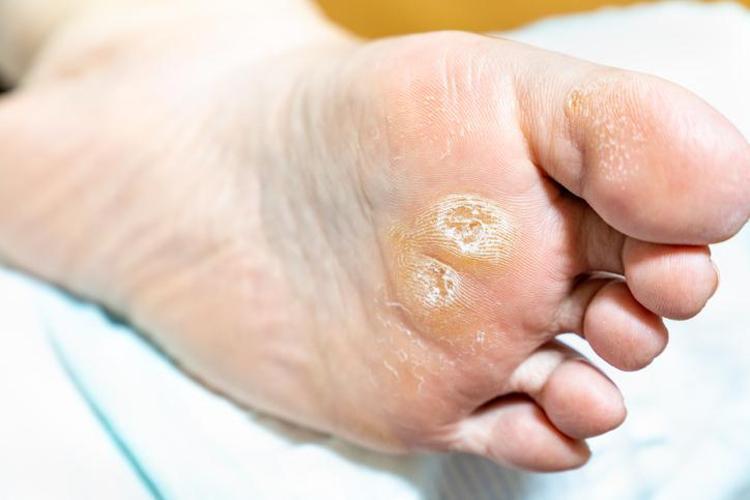 Mantarın kökünü kurutuyor Nasır, mantar ve egzamayı 1 gecede bitiriyor, doğal antibiyotik anında etki ediyor