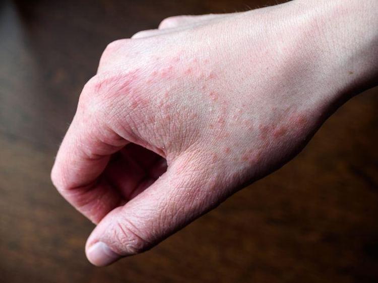 Sinek ısırığı kaşıntısını anında geçiriyor 1 damla sürmek yetiyor, cildi pamuk gibi yumuşatıp kızarıklığı ve şişliği silip atıyor