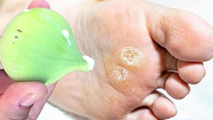 Ayakta ve ellerde oluşan nasırı kökünden söken yöntem Sertleşmeyi azaltarak cildi pamuk gibi yumuşacık yapıyor