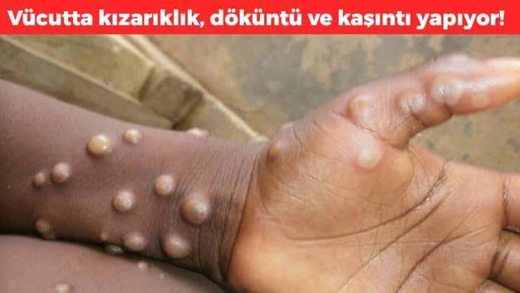 Bağışıklık sistemi zayıf olanlara bulaşıyor Ateş, halsizlik ve baş ağrısı yapıyor, cildinizde kırmızı benekler varsa dikkat