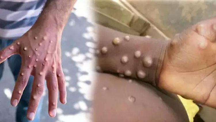 Maymun çiçeği aşısında dikkat çeken detay Atatürkün verdiği talimatla kurulmuş