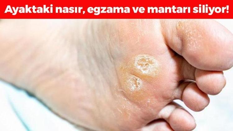 Nasır, egzama ve mantarın kökünü kazıyor 1 damlası yeterli oluyor, ayakları bebek gibi yumuşacık yapıyor