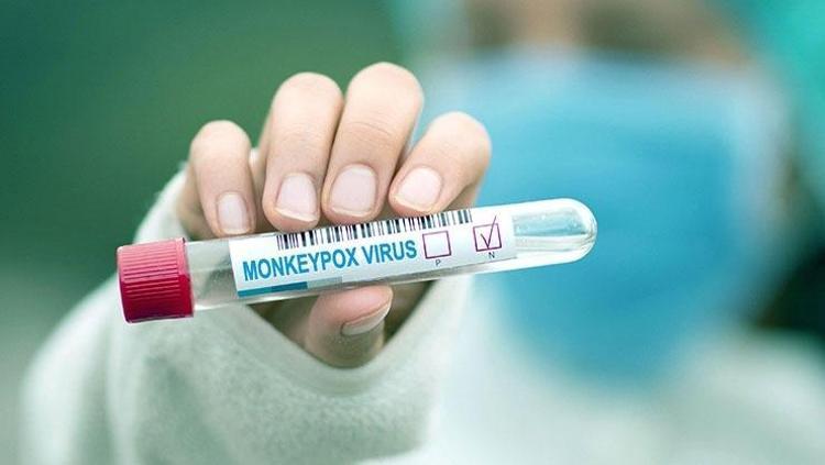 Maymun çiçeğinde ilk karantina başladı Salgında bir ilk: Karantina başladı, izler hem yüzünde hem de göğsünde belirdi
