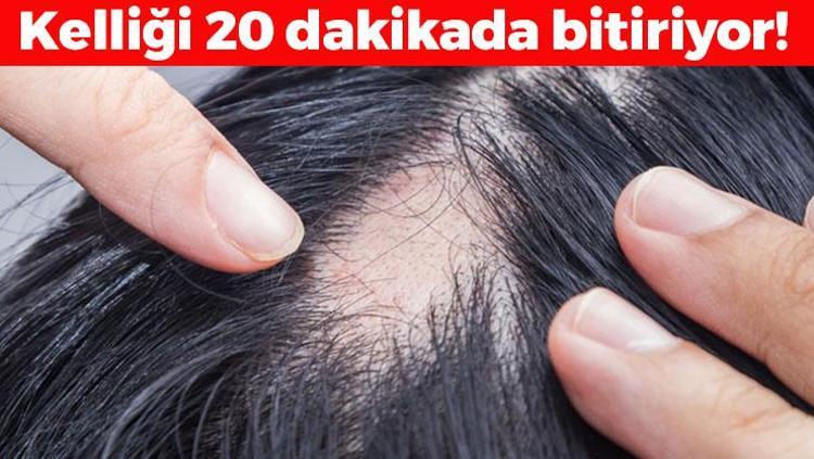20 dakikada saçkıranın kökünü kazıyor Egzama, mantar ve sedefi geçiriyor, saçların avuç avuç dökülmesini önlüyor Kelliğin en kesin ilacı