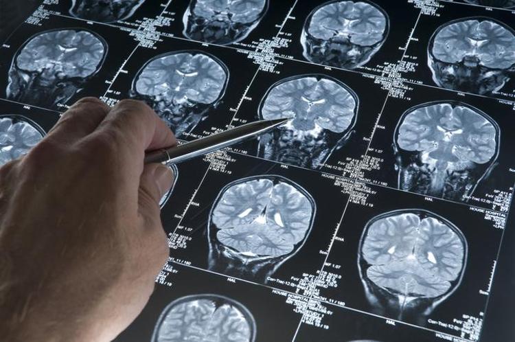 ALZHEIMER TETİKÇİSİ OLABİLİR