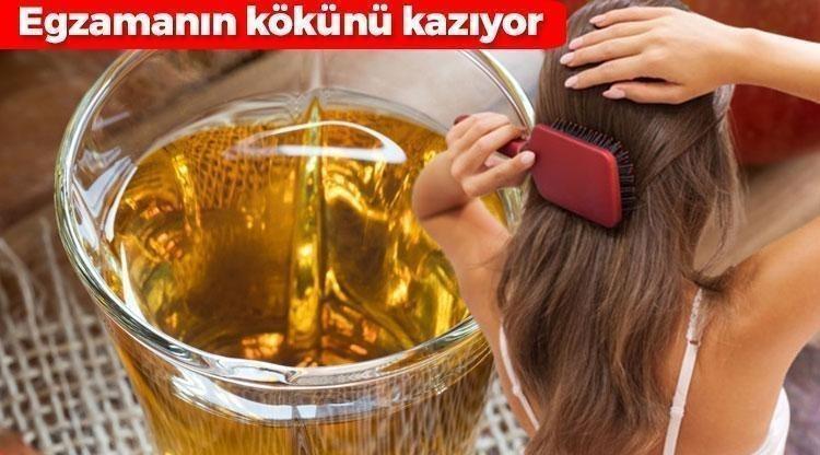 Egzama, kepek ve kaşıntının kökünü kurutuyor: Gece sürüp sabaha kadar bekletin