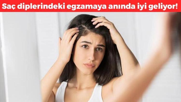 Saç diplerindeki egzama ve mantarın kökünü kurutuyor Gece sürüp sabaha kadar bekletmek yetiyor, kaşıntıdan eser bırakmıyor