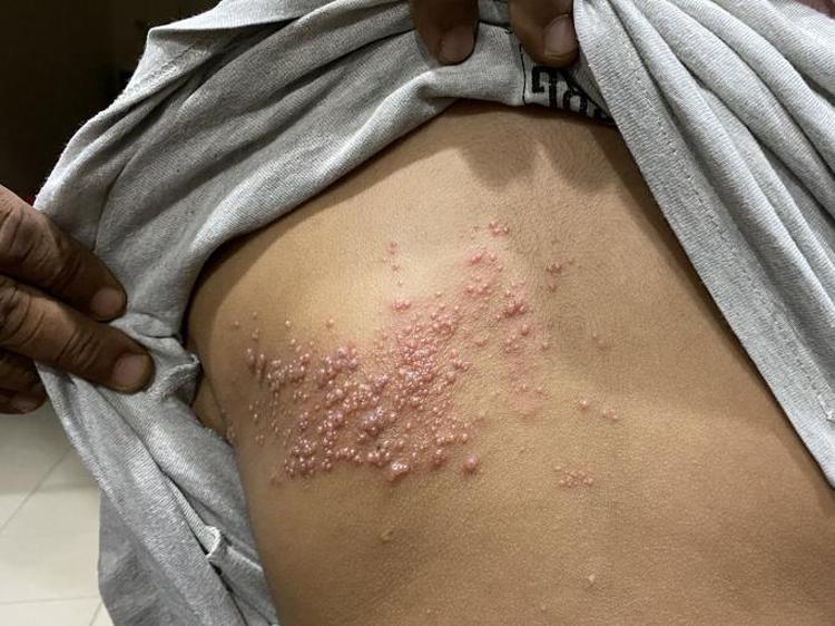 Halk arasında ‘gece yanığı’ olarak da biliniyor Ufak bir kızarıklıkla başlıyor: Ömür boyu süren ağrıların sebebi olabilir