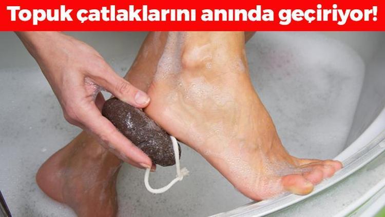 Topuk çatlaklarını anında geçiriyor Nasırın, mantarın ve kokunun kökünü kazıyor, 5 dakikada ayakları bebek gibi yumuşacık yapıyor