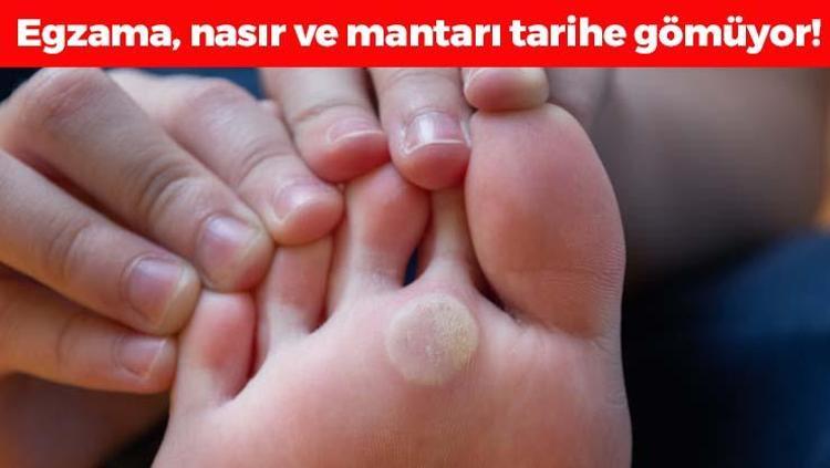 Mantarı kazıyıp atıyor Egzama, nasır, mantar ve kokuyu tarihe gömüyor 5 dakikada hazır, ayakları pamuk gibi yumuşacık yapıyor