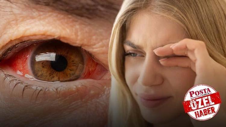 Gözde ufak bir kaşıntı ile kendini belli ediyor, mevsim geçişinde vaka sayısı tavan yapıyor Uzmanı uyardı: Makyaj malzemeleri asıl sebep olabilir