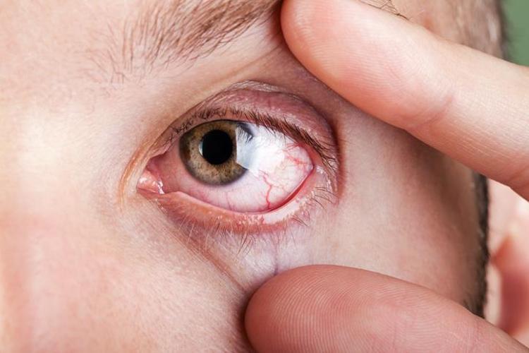 Gözde ufak bir kaşıntı ile kendini belli ediyor, mevsim geçişinde vaka sayısı tavan yapıyor Uzmanı uyardı: Makyaj malzemeleri asıl sebep olabilir