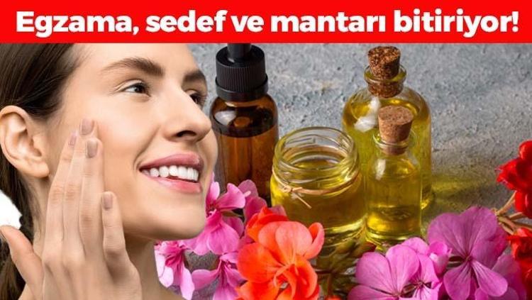 Egzama, sedef ve mantarın kökünü kurutuyor Kepek ve saç dökülmesini engelliyor, cildi bebek gibi yumuşacık yapıyor 1 damlası bile yetiyor