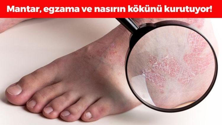 Egzamanın kökünü kurutuyor Nasır, mantar ve egzamayı tarihe gömüyor, 5 dakikada ayakları pamuk gibi yapıyor