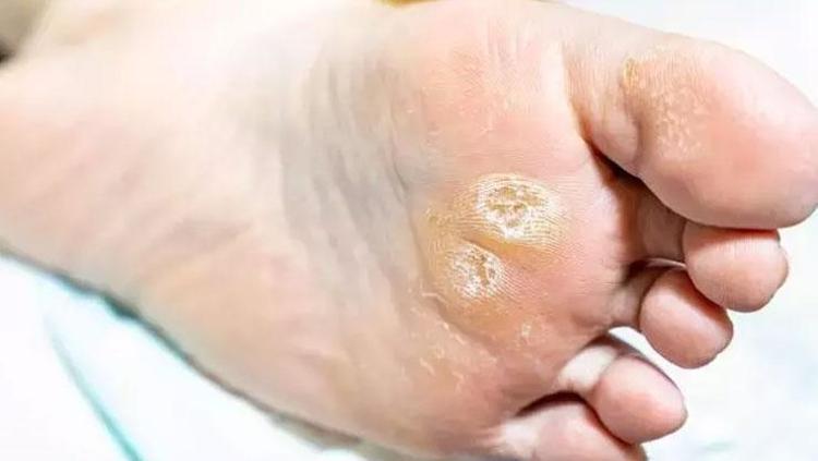 Nasırı 24 saatte yumuşatıp bitiriyor 3 malzemeyi karıştırıp sürün: Bebek gibi cilt için düzenli kullanın
