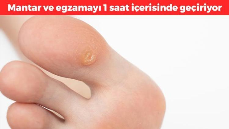 Nasırın kökünü kurutuyor Mantar ve egzamayı 1 saat içerisinde geçiriyor: Ayakları anında pamuk gibi yapıyor, sadece 2 malzemeyle hazırlanıyor