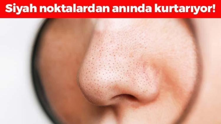 Siyah noktaların kökünü kurutuyor Sadece 2 malzemeyle hazırlanıyor: Cildi parıl parıl parlatıp komedonlardan ve siyah noktalardan kurtarıyor