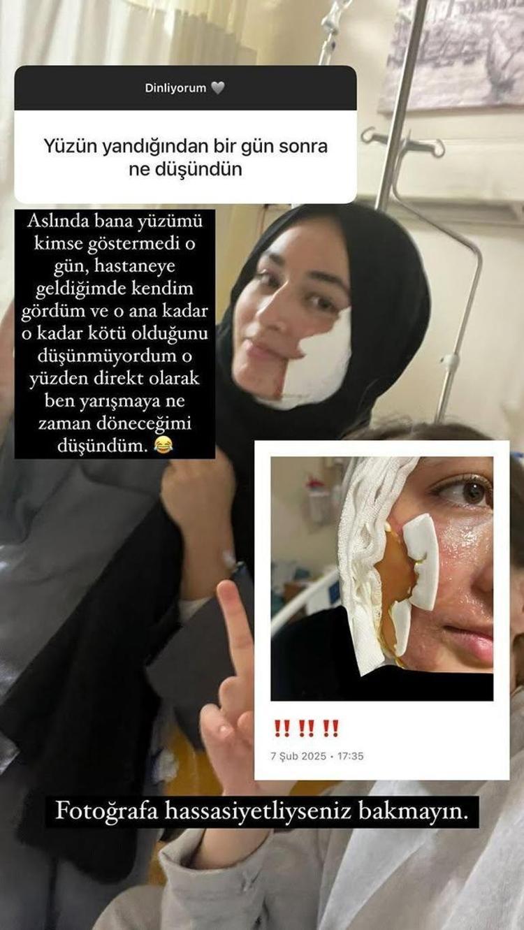 Masterchef Beyza kaza sonrası ilk defa en net halini paylaştı