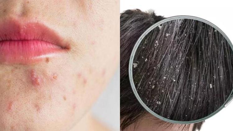 Avustralya’da bir numara Saç dökülmesini ve kepeği tarihe gömüyor: Akne tedavisinin doğal ilacı, anti-inflamatuar etkisi iltihabı kurutuyor