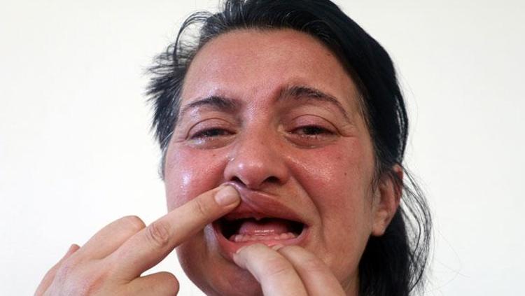 Halk arasında delirten hastalık olarak biliniyor Yüzün bir tarafında görülüyor, diş ağrısıyla karıştırılıyor