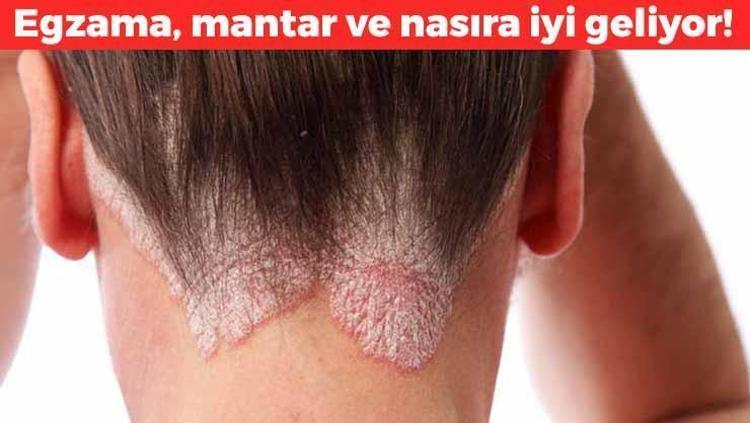 Egzama kremlerine para dökmeyin Kaşıktı ve kızarıklığı söküp atıyor: Cildi 5 dakikada pamuk gibi yapıyor