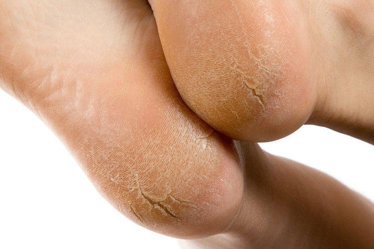 15 dakikada çatlamış topukları onarıyor Ayak çatlaklarına kesin çözüm, bu yöntem ayakları bebek gibi yapıyor