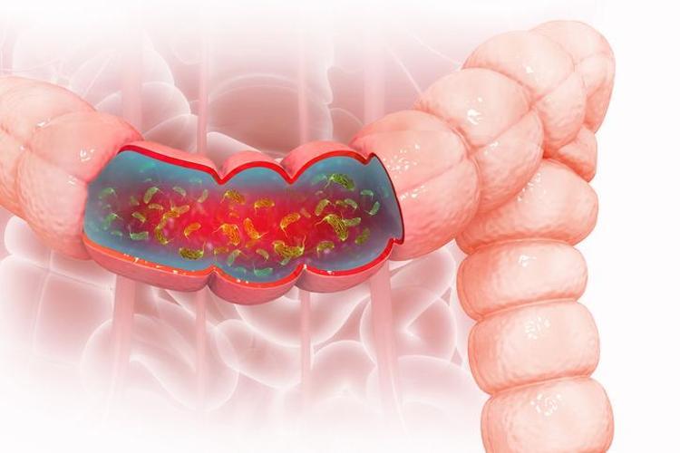 CROHN VE ÜLSERATİF KOLİT GİBİ ORGANİK DEĞİL
