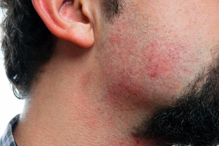 Bu bakliyat lazerden daha etkili 1 avuç kullananda bir daha tüy çıkmıyor