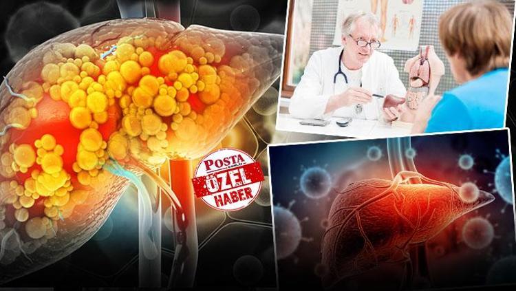 Belirti dahi vermeden sinsice ilerliyor, her 3 kişiden 1inde var Uzman isim uyardı: Tedavi edilmezse sirozla sonuçlanabilir