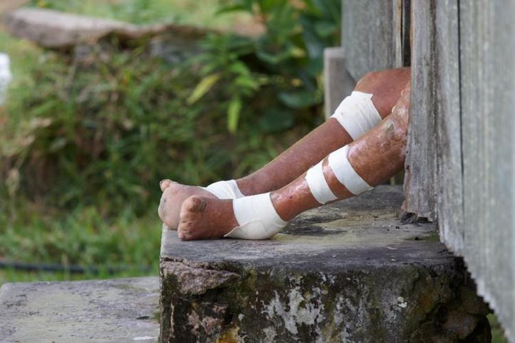 Evlenmeleri, sokağa çıkmaları ve çocuk sahibi olmaları yasak Tarihçiler anlatıyor: Bu hastalığa yakalananlar ölü ilan ediliyordu
