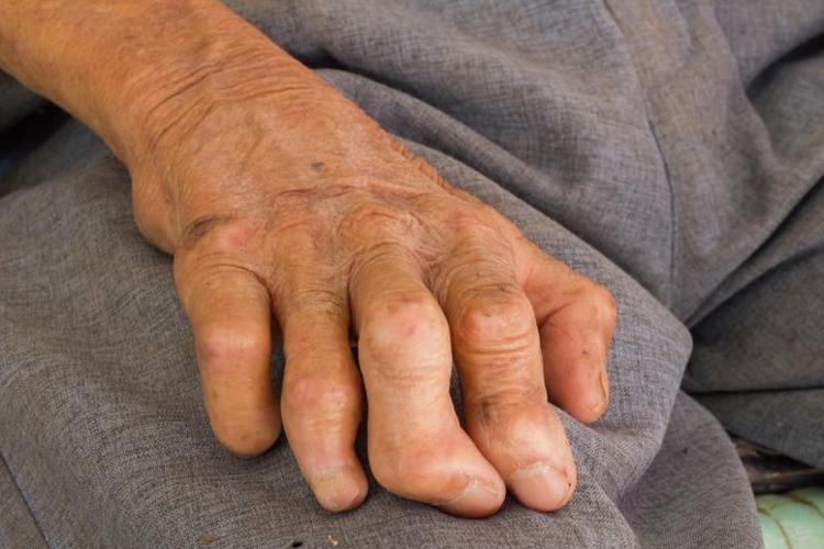 Evlenmeleri, sokağa çıkmaları ve çocuk sahibi olmaları yasak Tarihçiler anlatıyor: Bu hastalığa yakalananlar ölü ilan ediliyordu