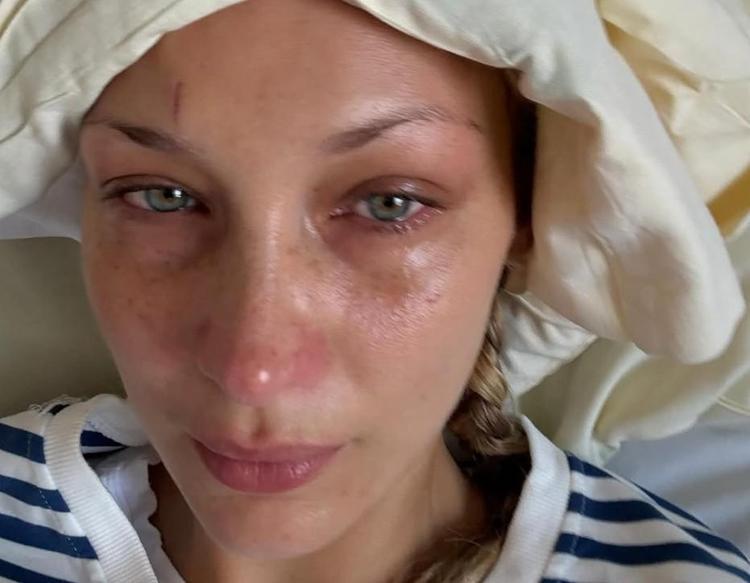 Bella Hadid’den hüzünlendiren paylaşım: Lyme hastalığıyla mücadelesini anlattı
