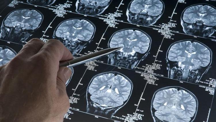 Yapay zeka epilepside çığır açtı Çocukların beynindeki gizli lezyonları tespit etti