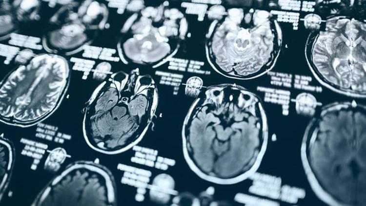 YAPAY ZEKÂ EPİLEPSİ TEŞHİSİNDE YENİ BİR ÇAĞ AÇTI