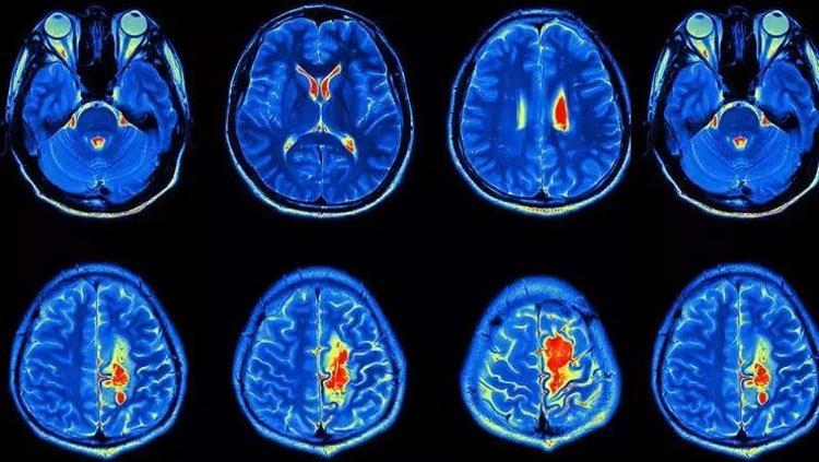 Yapay zeka epilepside çığır açtı Çocukların beynindeki gizli lezyonları tespit etti