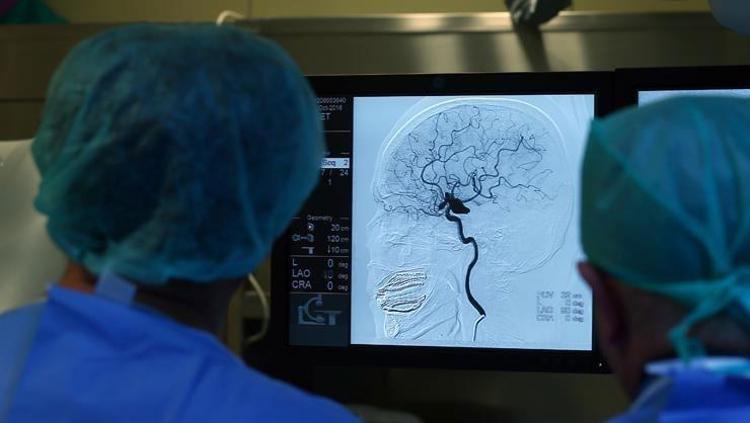 Yapay zeka epilepside çığır açtı Çocukların beynindeki gizli lezyonları tespit etti