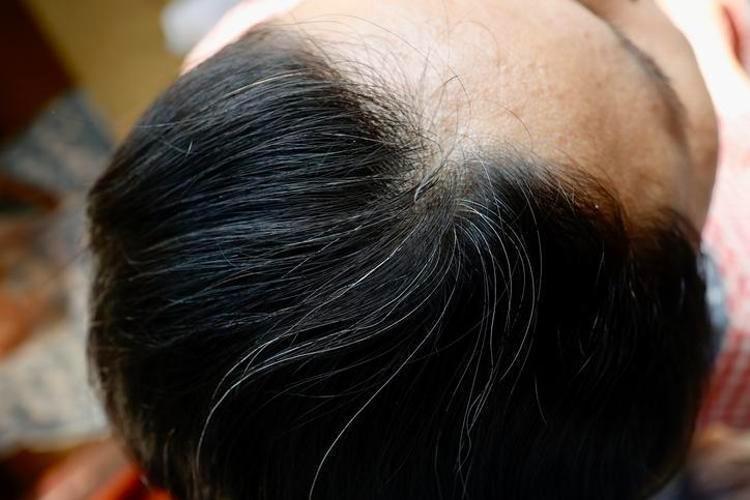 Beyaz saç koparılınca çoğalır mı