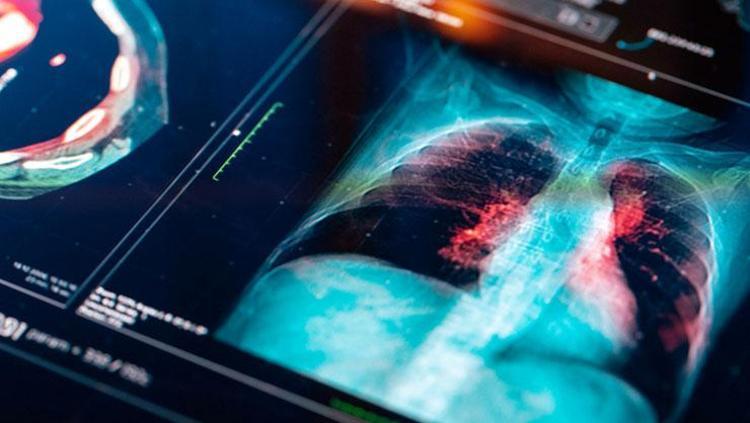 Her yıl binlerce kişinin ölmesine neden oluyor Uzmanlar sessiz tehlike zatürreye karşı uyarıyor