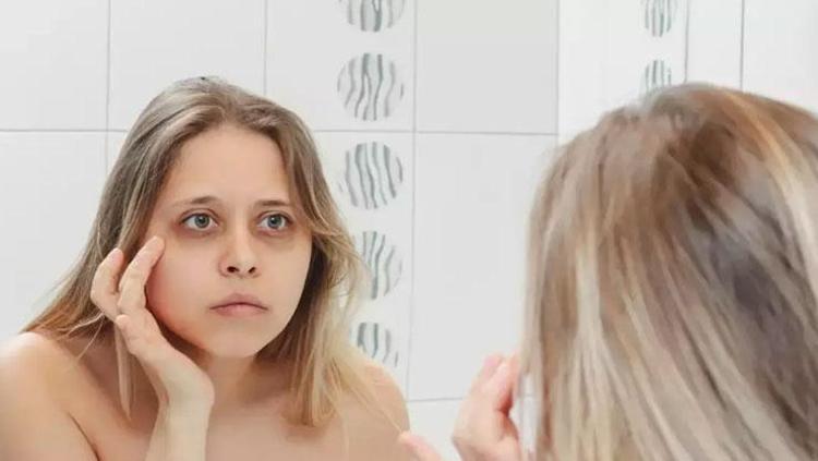 Göz altlarını cam gibi yapıyor Koyu görünümü bitiriyor