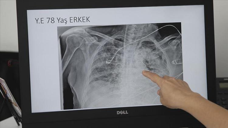 Her 100 kişiden birinde görülüyor Ölüm oranı çok yüksek