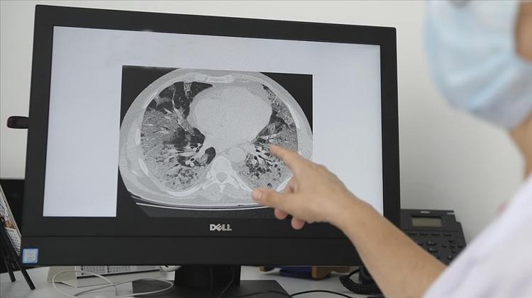 Her 100 kişiden birinde görülüyor Ölüm oranı çok yüksek